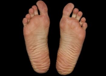 Identifying and Managing Fungal Skin Infections