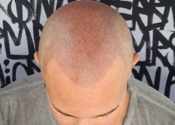 The Benefits of Using Hairline Tattoos to Thicken Hairline