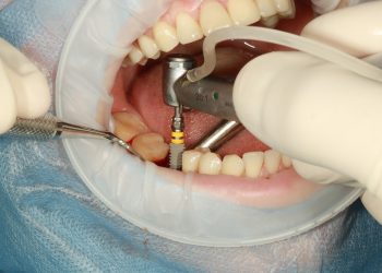 What Every Patient Needs To Know About Dental Implants In Turkey