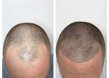 Things To Know About Scalp Micropigmentation