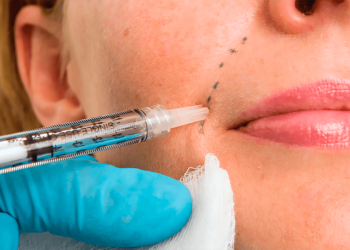 Convenience and Longevity: Understanding Dermal Fillers