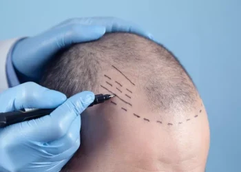 Journey to a New Mane: The Appeal of Hair Transplant Procedures in Turkey