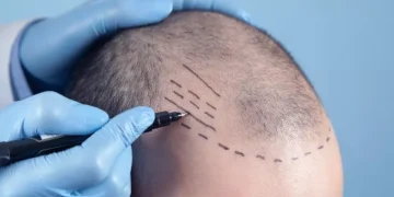 Journey to a New Mane: The Appeal of Hair Transplant Procedures in Turkey