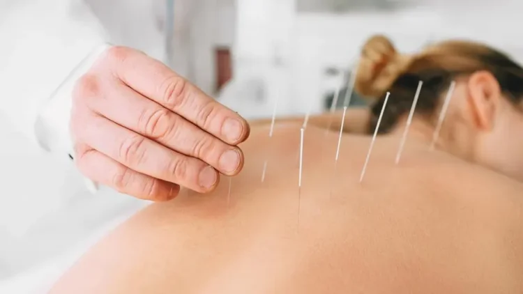 Demystifying Acupuncture: What To Expect From Treatments in South Kensington