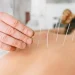 Demystifying Acupuncture: What To Expect From Treatments in South Kensington