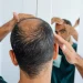 Balancing Benefits and Risks: Topical Finasteride in Hair Loss Treatment