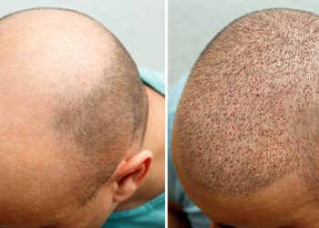 Revitalizing Your Look with Hair Transplant Surgery