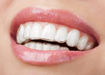 New Malden Smiles: Embracing the Invisalign Revolution for Straighter Teeth