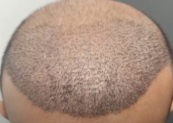 Innovative Techniques in Hair Implants for Effective Hair Restoration