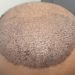 Innovative Techniques in Hair Implants for Effective Hair Restoration