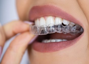 Achieving Your Perfect Smile with Modern Aligners