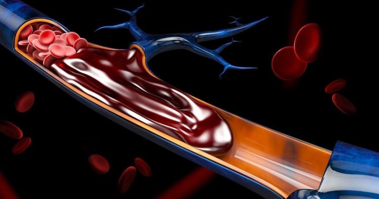 Raising Awareness About Blood Clots: The Role of Non-Profits in Educating the Public and Preventing Tragedies