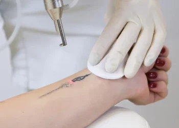 Beyond the Needle: A Realistic Look at Tattoo Removal in Preston