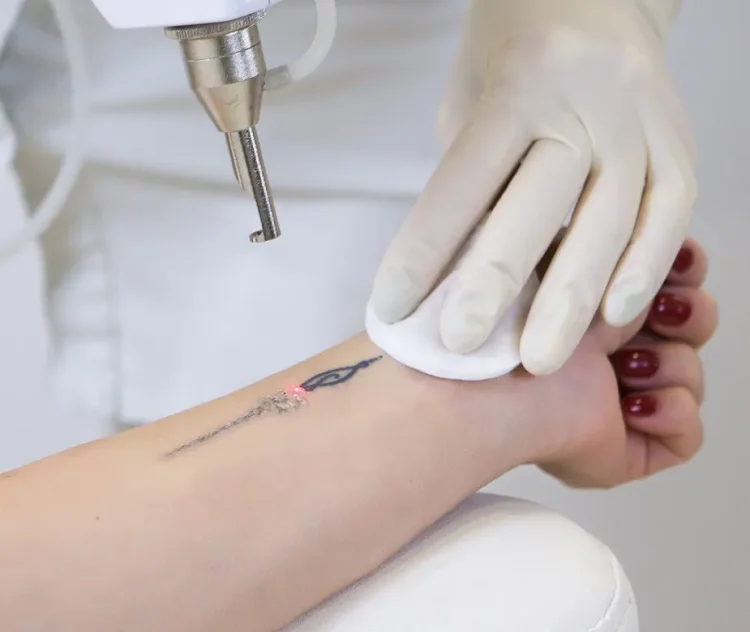 Beyond the Needle: A Realistic Look at Tattoo Removal in Preston