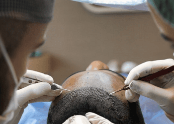 The Practical Power of Recent Hair Transplant Reviews: Expectations, Costs and Outcomes