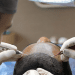 The Practical Power of Recent Hair Transplant Reviews: Expectations, Costs and Outcomes